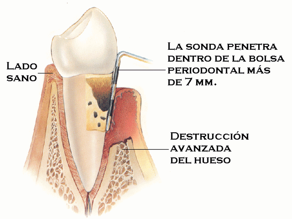 Centros Dentales Lucena Estepa Herrera - Montse Rojas - Ramn Luis Banchs - Dentista de Confianza - Enfermedad Periodontal
